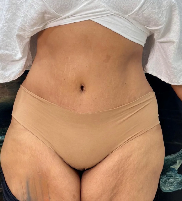Abdominoplasty After